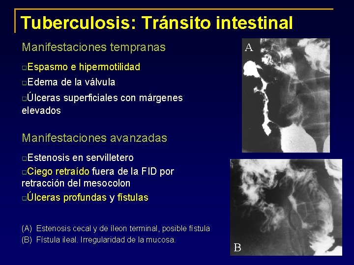 Tuberculosis: Tránsito intestinal A Manifestaciones tempranas Espasmo e hipermotilidad q Edema de la válvula