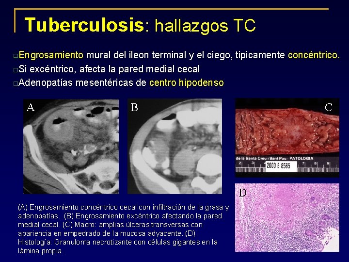 Tuberculosis: hallazgos TC Engrosamiento mural del ileon terminal y el ciego, tipicamente concéntrico. o.