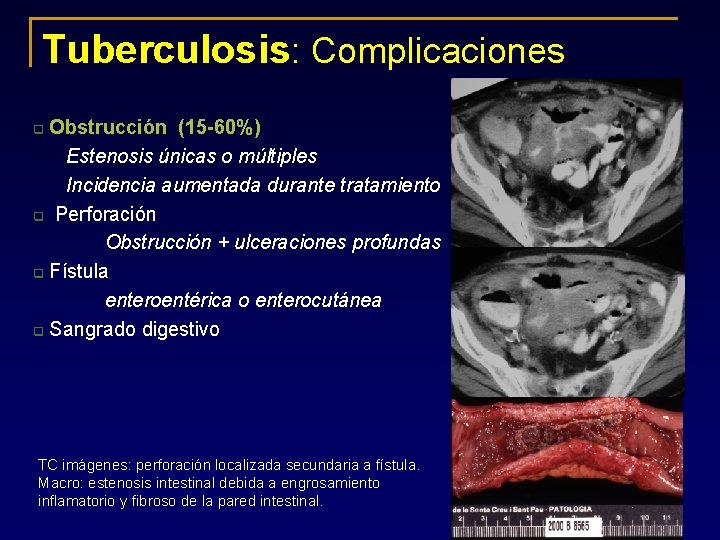 Tuberculosis: Complicaciones Obstrucción (15 -60%) Estenosis únicas o múltiples Incidencia aumentada durante tratamiento q