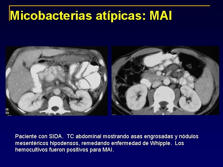Micobacterias atípicas: MAI Paciente con SIDA. TC abdominal mostrando asas engrosadas y nódulos mesentéricos