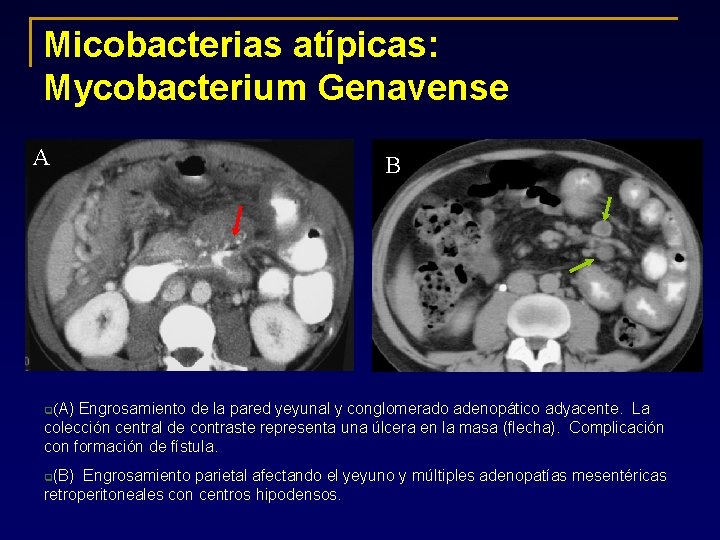 Micobacterias atípicas: Mycobacterium Genavense A B Engrosamiento de la pared yeyunal y conglomerado adenopático