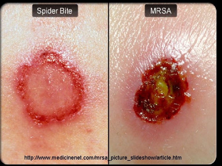 http: //www. medicinenet. com/mrsa_picture_slideshow/article. htm 