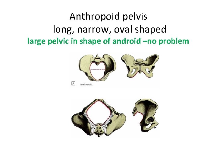 Anthropoid pelvis long, narrow, oval shaped large pelvic in shape of android –no problem