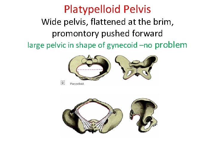 Platypelloid Pelvis Wide pelvis, flattened at the brim, promontory pushed forward large pelvic in