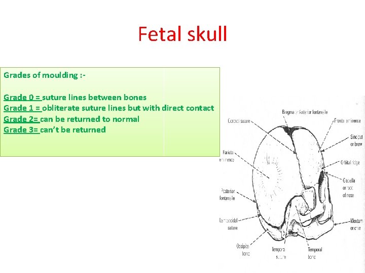 Fetal skull Grades of moulding : Grade 0 = suture lines between bones Grade