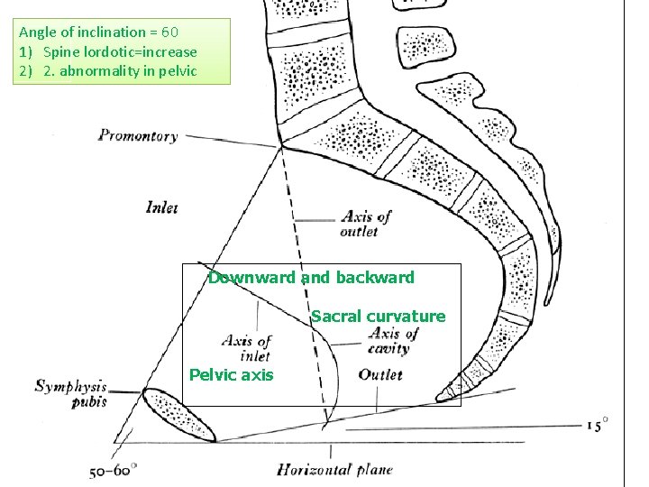 Angle of inclination = 60 1) Spine lordotic=increase 2) 2. abnormality in pelvic Downward