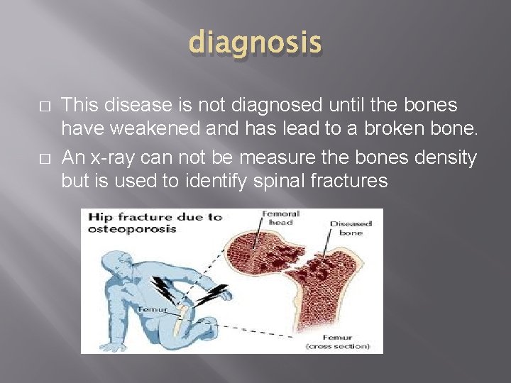 diagnosis � � This disease is not diagnosed until the bones have weakened and