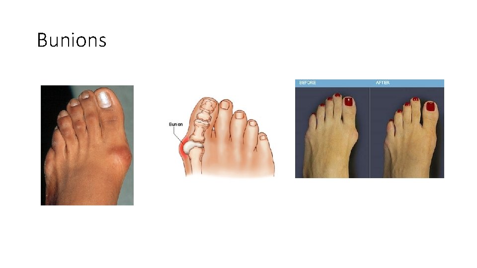 Bunions 