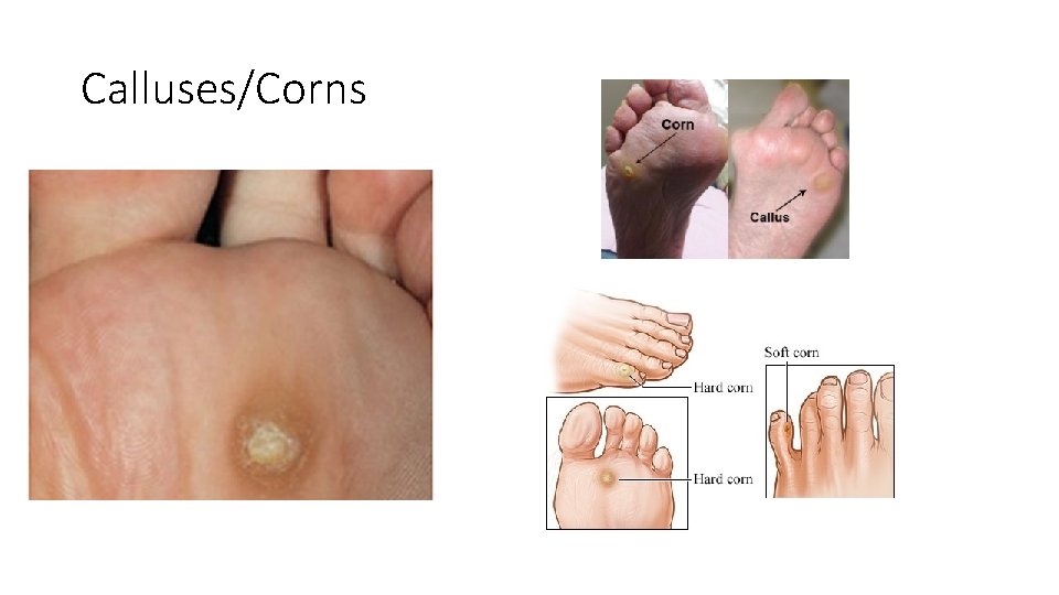 Calluses/Corns 