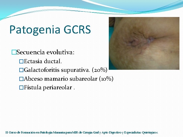 Patogenia GCRS �Secuencia evolutiva: �Ectasia ductal. �Galactoforitis supurativa. (20%) �Abceso mamario subareolar (10%) �Fístula