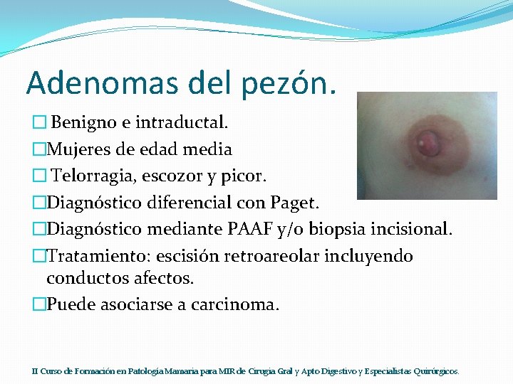 Adenomas del pezón. � Benigno e intraductal. �Mujeres de edad media � Telorragia, escozor