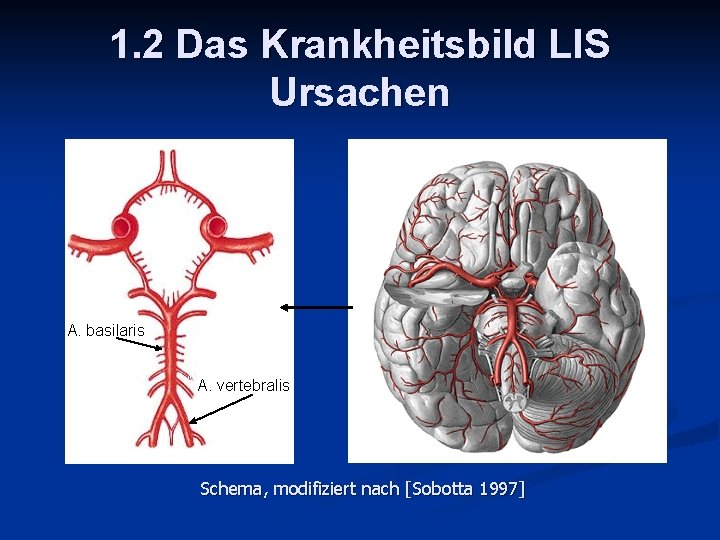 1. 2 Das Krankheitsbild LIS Ursachen A. basilaris A. vertebralis Schema, modifiziert nach [Sobotta