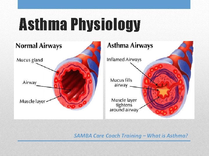 Asthma Physiology SAMBA Care Coach Training – What is Asthma? 