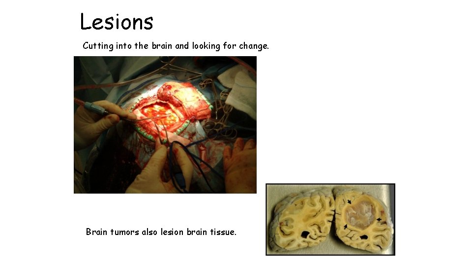 Lesions Cutting into the brain and looking for change. Brain tumors also lesion brain