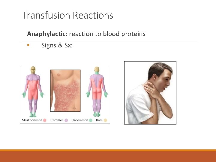 Transfusion Reactions Anaphylactic: reaction to blood proteins • Signs & Sx: 
