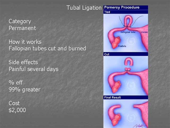 Tubal Ligation Category Permanent How it works Fallopian tubes cut and burned Side effects