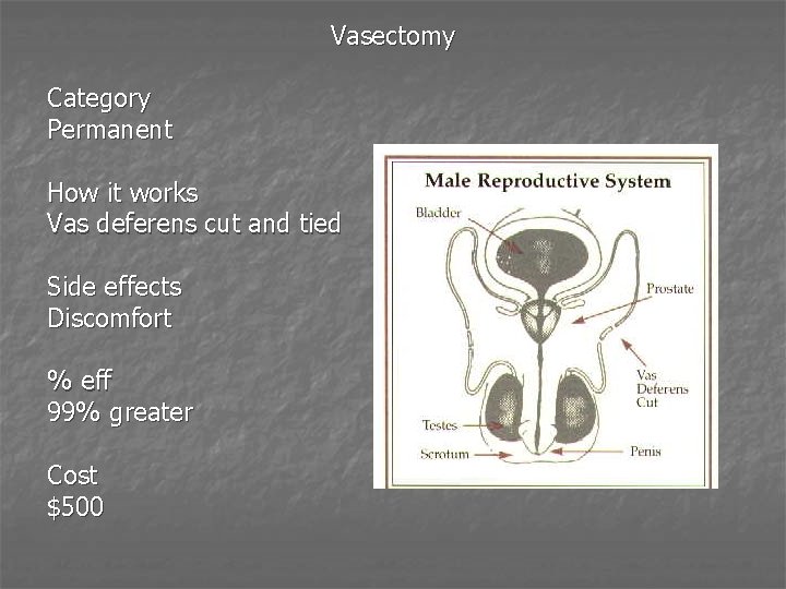 Vasectomy Category Permanent How it works Vas deferens cut and tied Side effects Discomfort