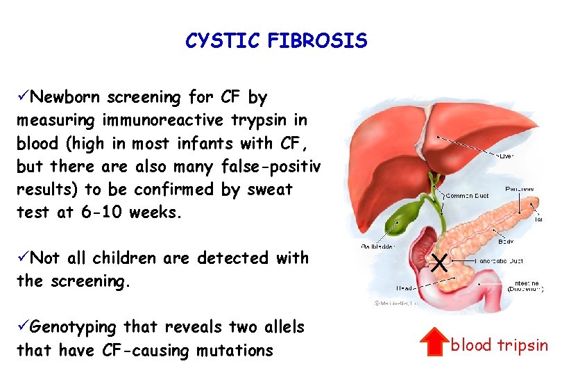CYSTIC FIBROSIS üNewborn screening for CF by measuring immunoreactive trypsin in blood (high in