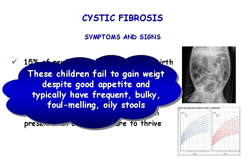 CYSTIC FIBROSIS SYMPTOMS AND SIGNS ü 15% of newborn with CF present at birth