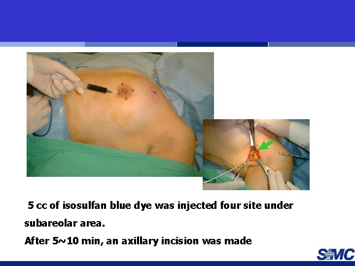 5 cc of isosulfan blue dye was injected four site under subareolar area. After