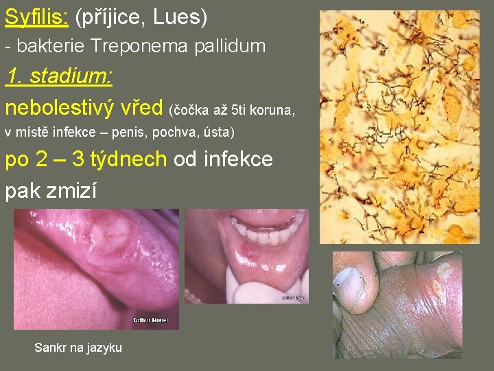 Syfilis: (příjice, Lues) - bakterie Treponema pallidum 1. stadium: nebolestivý vřed (čočka až 5