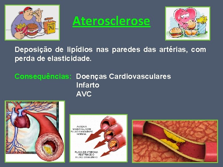 Aterosclerose Deposição de lipídios nas paredes das artérias, com perda de elasticidade. Consequências: Doenças