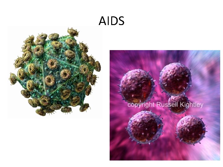 AIDS 