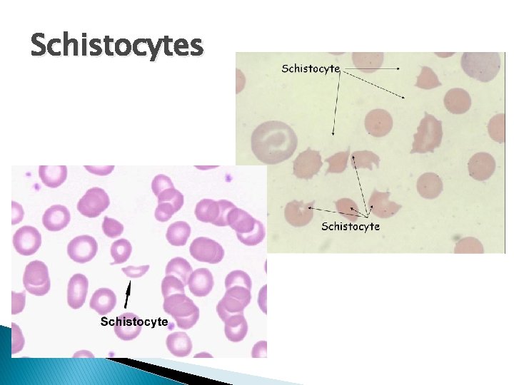 Schistocytes 