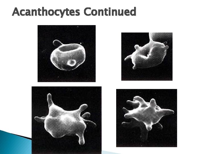 Acanthocytes Continued 