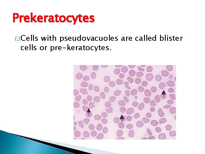 Prekeratocytes � Cells with pseudovacuoles are called blister cells or pre-keratocytes. 
