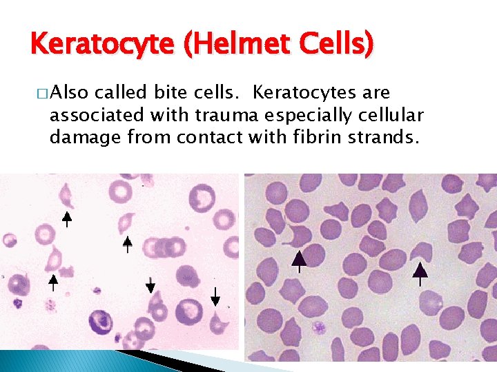 Abnormalities in Erythrocytes Laboratory Procedures Polychromasia Can exist