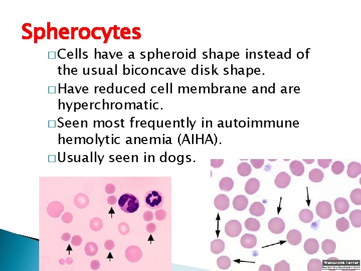 Spherocytes � Cells have a spheroid shape instead of the usual biconcave disk shape.