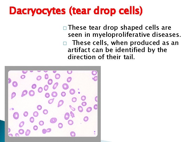 Dacryocytes (tear drop cells) � These tear drop shaped cells are seen in myeloproliferative