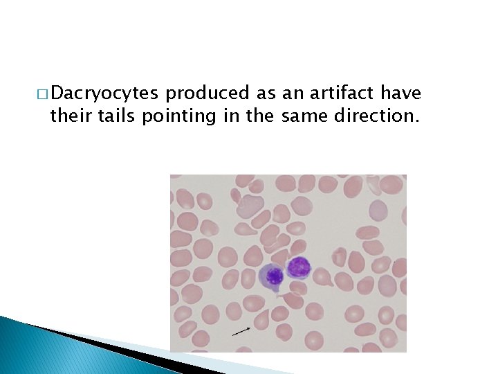 � Dacryocytes produced as an artifact have their tails pointing in the same direction.