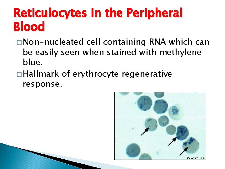 Reticulocytes in the Peripheral Blood � Non-nucleated cell containing RNA which can be easily