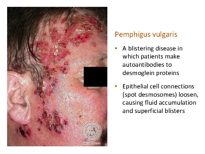 Pemphigus vulgaris • A blistering disease in which patients make autoantibodies to desmoglein proteins