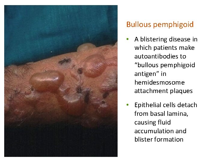Bullous pemphigoid • A blistering disease in which patients make autoantibodies to “bullous pemphigoid