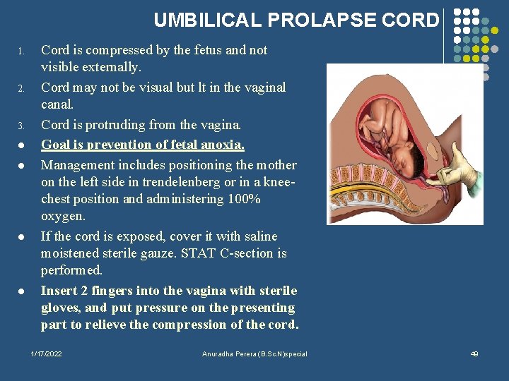 UMBILICAL PROLAPSE CORD 1. 2. 3. l l Cord is compressed by the fetus