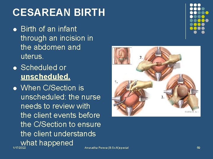 CESAREAN BIRTH l l l Birth of an infant through an incision in the