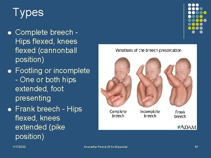 Types l l l Complete breech Hips flexed, knees flexed (cannonball position) Footling or