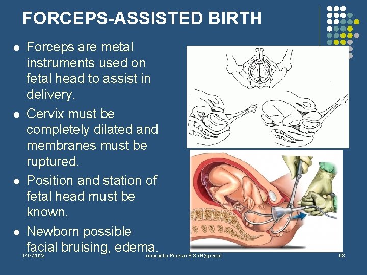 FORCEPS-ASSISTED BIRTH l l Forceps are metal instruments used on fetal head to assist