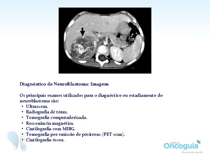 Diagnóstico de Neuroblastoma: Imagem Os principais exames utilizados para o diagnóstico ou estadiamento do