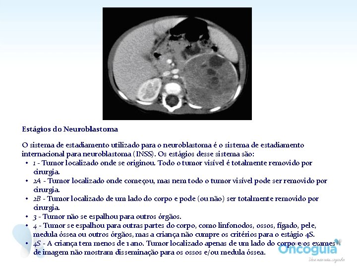 Estágios do Neuroblastoma O sistema de estadiamento utilizado para o neuroblastoma é o sistema