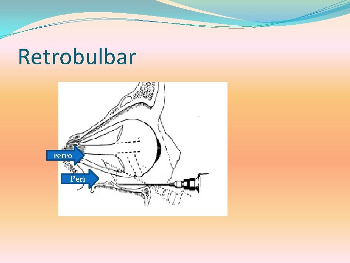 Retrobulbar retro Peri 