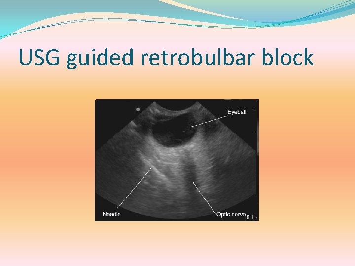 USG guided retrobulbar block 