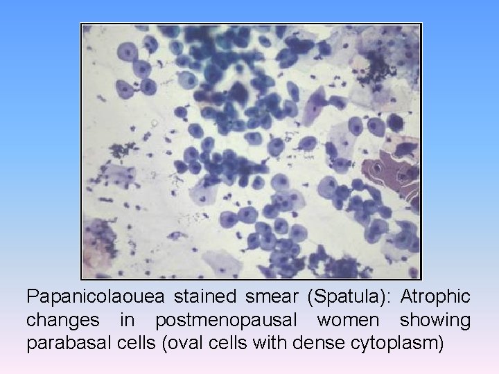 Papanicolaouea stained smear (Spatula): Atrophic changes in postmenopausal women showing parabasal cells (oval cells