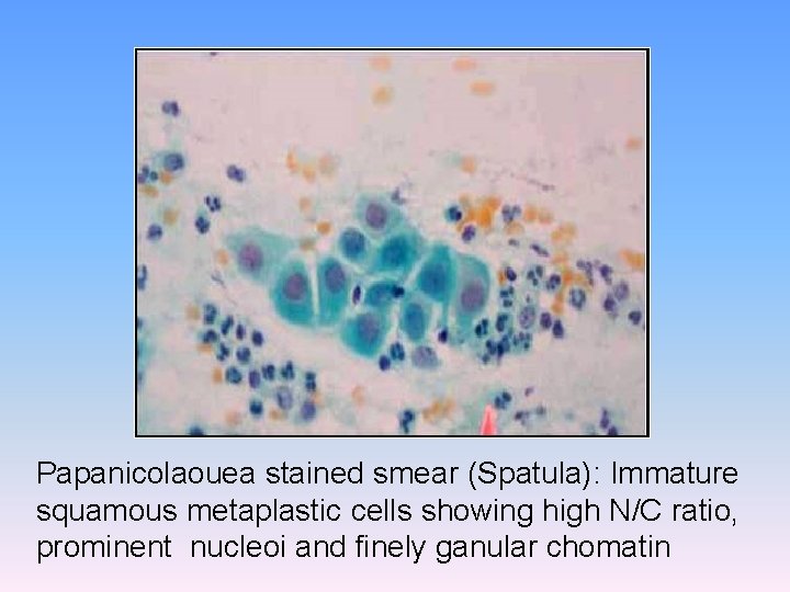 Papanicolaouea stained smear (Spatula): Immature squamous metaplastic cells showing high N/C ratio, prominent nucleoi