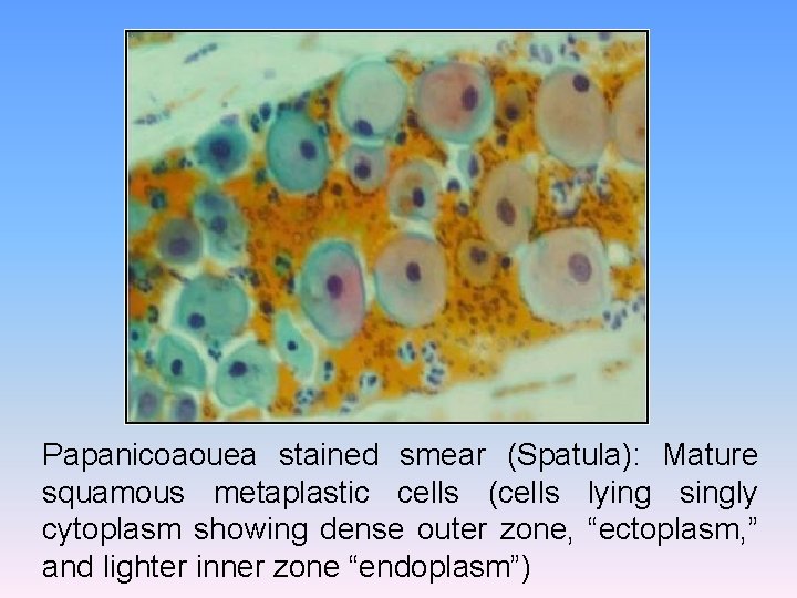 Papanicoaouea stained smear (Spatula): Mature squamous metaplastic cells (cells lying singly cytoplasm showing dense