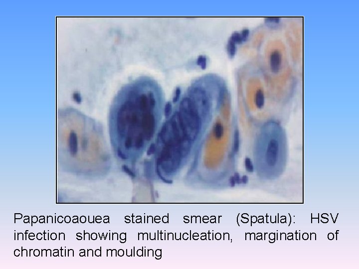 Papanicoaouea stained smear (Spatula): HSV infection showing multinucleation, margination of chromatin and moulding 