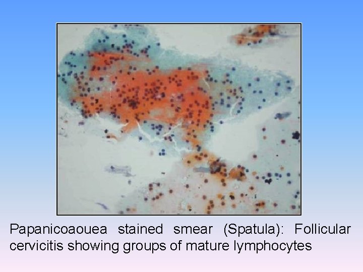Papanicoaouea stained smear (Spatula): Follicular cervicitis showing groups of mature lymphocytes 